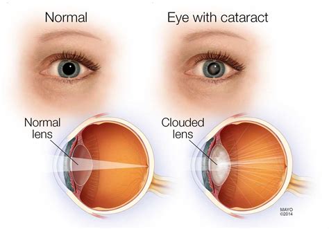 eye test for cataract pain